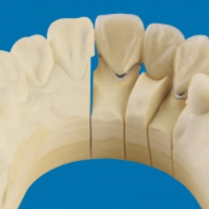 Metal-dientes de porcelana